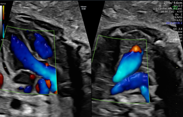 ecocardiograma-fetal